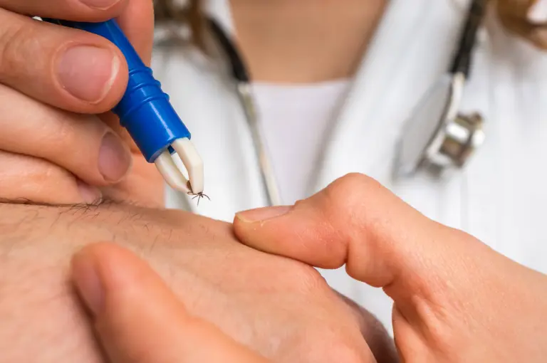 Zeckenentfernung mit Pinzette zur Vorbeugung von FSME und Borreliose – Hausarzt Neuhausen bietet FSME-Impfung in München an, Zeckenzange, Zeckensaison, Zeckenbiss, Symptome Rötung bei Zeckenbiss, Wann zum Arzt bei Zeckenbiss, Zeckenimpfung München, FSME-Impfung Bayern, Zecken entfernen richtig, Zeckenschutz Tipps